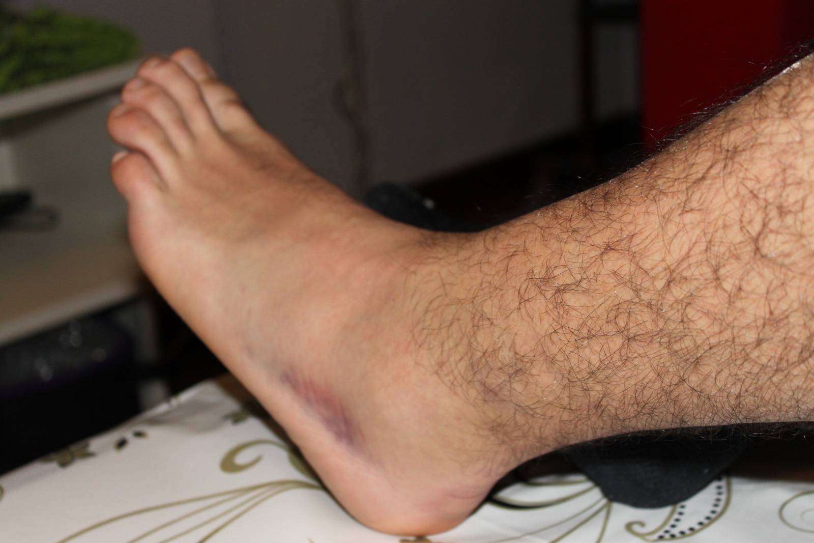 IMG_5493 Alberto es deportista. Enseña el esguince que se ha hecho al jugar al futbol